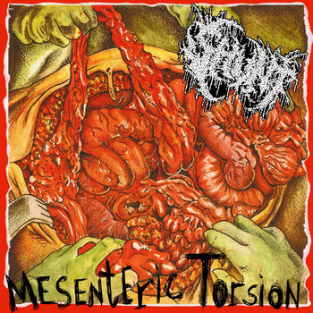 Mesenteric Torsion