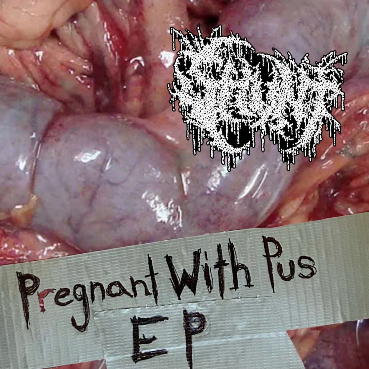 Pregnant with Pus